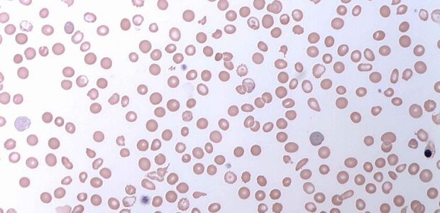 Sickle cell disease affects millions of people worldwide and is caused by a genetic mutation that produces abnormal hemoglobin, which clumps together making sickle-, or […]